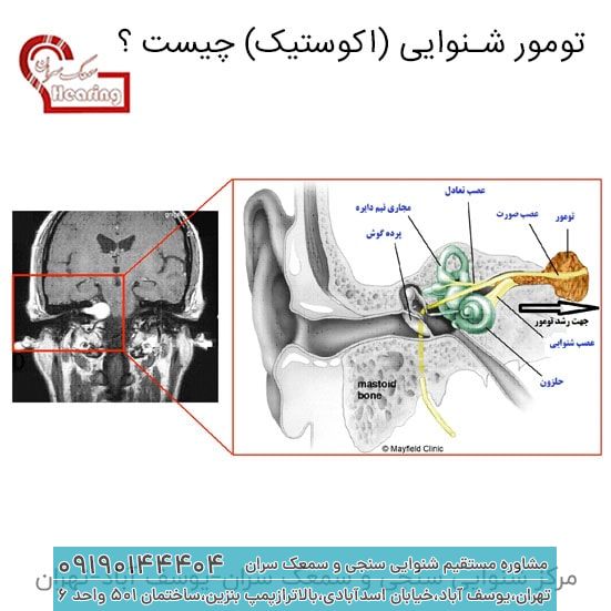 تومور شنوایی (اکوستیک) چیست